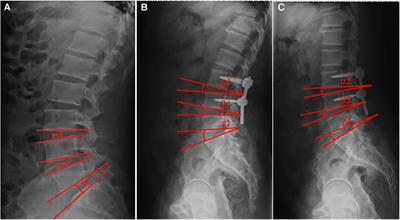 Using the pedicle screw-U rod system for the treatment of double-level lumbar spondylolysis and isthmic spondylolisthesis